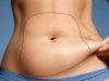 Expert Recovery Guidance from Best Liposuction Surgeons in Dubai