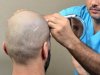 Hair Transplant in Dubai – Restore Hair. Reclaim Confidence.