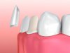 Everything You Need to Know About Porcelain Veneers at Gentle Dentistry of Las Colinas in Irving, TX