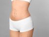 Under the Knife, Over the Top: Liposuction in the Limelight