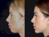How Chin Fillers Treatment in Dubai Can Boost Your Confidence