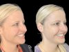 Natural-Looking Botox Results: Tips from the Best Doctors in dubai