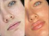 Fillers in Dubai: Restore Volume and Youthful Contours