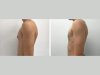 The Best Gynecomastia Surgeons in Dubai for Natural-Looking Results
