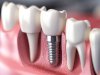 What to Expect During a Dental Implant Procedure in North York