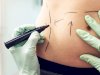 Factors That Affect Liposuction Cost in Dubai