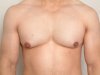 Does Weight Loss Eliminate Gynecomastia Completely?