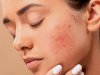 Discover the Best Homeopathy Treatment for Acne in Dubai: A Natural Path to Clear Skin