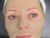 What Is Cosmelan Peel and How Does It Work?