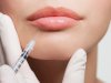 Are Lip Fillers Permanent?