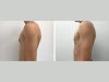 Male Boob Surgery in Dubai: Understanding the Benefits of Gynecomastia Surgery