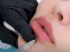 How Many Syringes Are Needed for Russian Lip Look?