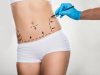 The Future of Liposuction: Trends to Watch in 2025 and Beyond