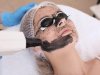 Can Laser Carbon Peel Help With Acne and Oily Skin?