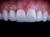 Composite Veneers and Diet: How Food Impacts Longevity