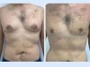 Gynecomastia in Dubai: Top Surgical Options for Male Chest Contouring