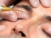 What Areas Can Be Treated with Plasma Pen?