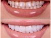 Dental Implants in Sacramento: A Complete Guide to Restoring Your Smile