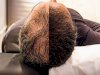 Does Hair Transplantation Work for Everyone in Islamabad?