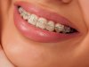 6 Common Braces Problems and How to Fix Them