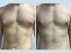 Post-Op Care Tips from the Best Gynecomastia Surgeon in Dubai