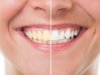 Why Teeth Whitening Cost Varies So Much in Different Places