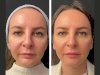 How the Best Aesthetic Clinics in Dubai Customize Mesotherapy for Every Skin Type