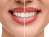 What Tiny Habits Drive Up Teeth Whitening Cost?