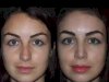 How Best Septoplasty Surgeons in Dubai Are Redefining Nasal Health