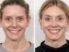 Innovations in Thread Lift Technology Used by the Best Doctors in Dubai