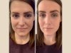 PRP Treatment in Dubai: A Complete Guide for Beginners