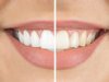 Is Teeth Whitening Cost Higher for Sensitive Teeth Cases?