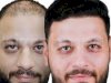 ما الذي يحدد تكلفة زراعة الشعر في الرياض؟