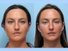 Achieve Flawless Contours Using Thread Lift Provided by the Best Doctors in Dubai