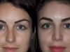 Rhinoplasty in Dubai: Enhancing Beauty and Breathing