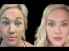 Combining Laser Treatments with Botox in Dubai: What You Need to Know