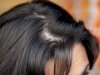 Hair Loss Treatment or Hair Transplant: Which Should You Choose?