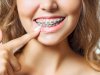 How Do Teeth Braces Costs in Dubai Impact Treatment Choice?