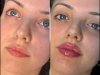 Before and After: Real Results of Fillers Treatment in dubai