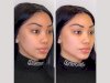 Enhance Confidence Through Affordable Thread Lift Treatments in Dubai Options