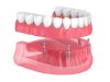 How to Choose the Right Dentures for Your Needs 