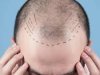 دليلك الشامل حول زراعة الشعر في الرياض: التقنيات، التكلفة، والنتائج المتوقعة