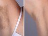 Laser hair removal in Dubai: Benefits for Men and Women
