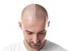 Affordable Hair Transplant in Islamabad’s F-7 and F-10 Areas