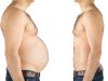 Bariatric Surgery Myths vs. Facts in Islamabad
