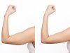 Why "Ozempic Body" Patients are Flocking to Arm Lift Surgery in Riyadh
