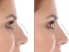 Best Septoplasty Surgeons in Dubai for Evidence-Based Correction