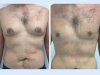 Best Gynecomastia Surgeons in dubai: A Safe and Effective Choice