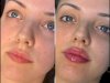 Best Aesthetic Clinic in Dubai for Fillers: Trusted by Beauty Experts