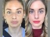 Visible Results with Radiofrequency (RF) Microneedling by the Best Aesthetic Clinic in Dubai